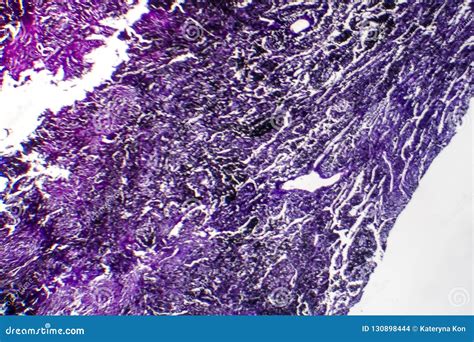 Histopathology of Silicosis, Light Micrograph Stock Photo - Image of eosin, morphological: 130898444