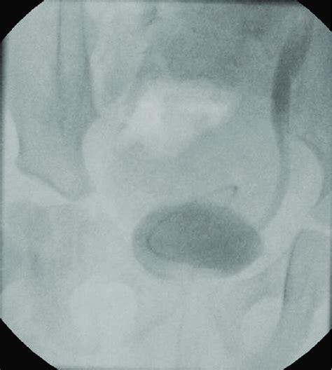 Low-pressure vesicoureteral reflux. The vesicoureteral reflux occurred ...