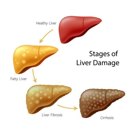 Liver Cirrhosis Illustrations, Royalty-Free Vector Graphics & Clip Art - iStock