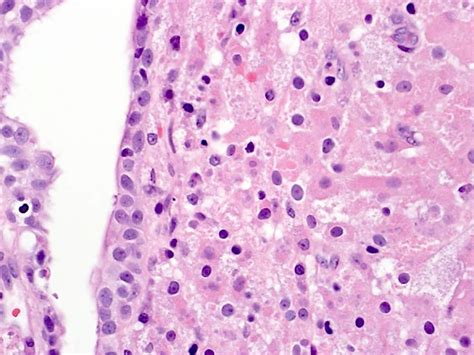 Pathology Outlines - Malakoplakia