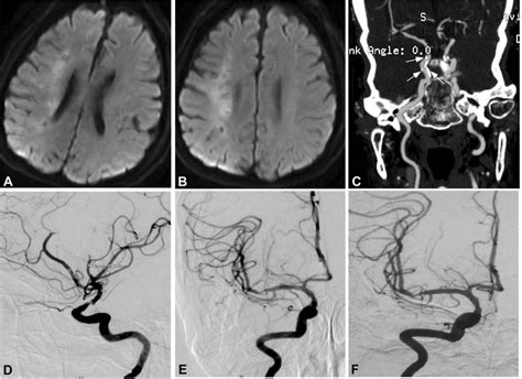 Right internal carotid artery severe stenosis. (A) Magnetic resonance ...