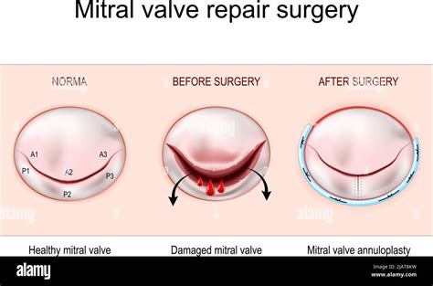 Mitral valve repair surgery. Healthy mitral valve. Damaged mitral valve before and after ...