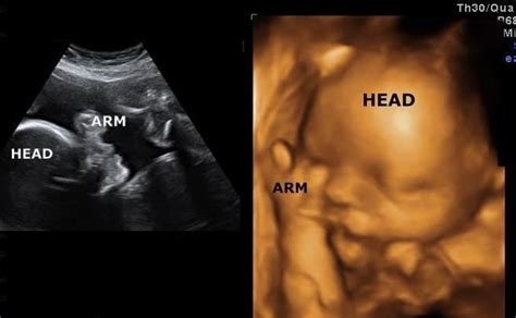 30 week 3d ultrasound images | 3d ultrasound, Ultrasound, 30 week ultrasound