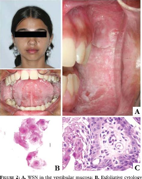 [PDF] Familial case of oral white sponge nevus--a rare hereditary ...