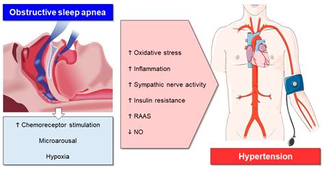 IJMS | Free Full-Text | The Effect of Continuous Positive Airway Pressure Therapy on Obstructive ...