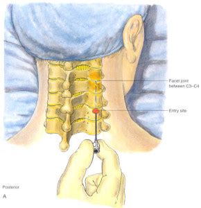 Cervical Facet Joint Block