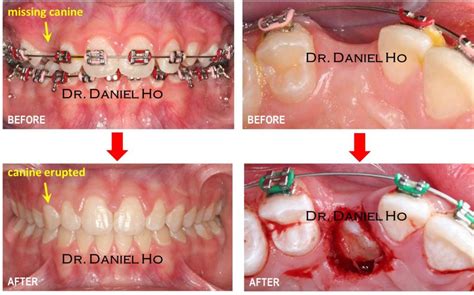 Impacted Canines Houston, TX | Dr. Coker & Dr. Ho | Exposure