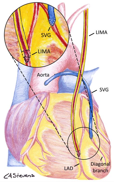 Left Internal Mammary Artery Graft - art-fidgety