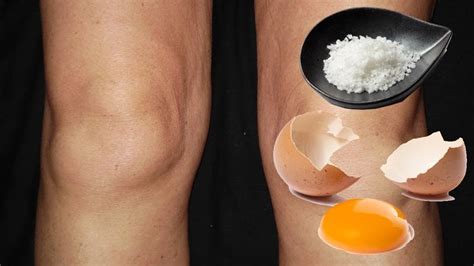 Natural 2 Ingredient Home Remedy For Treating Swollen Knees | Swollen knee, Home remedies, Remedies