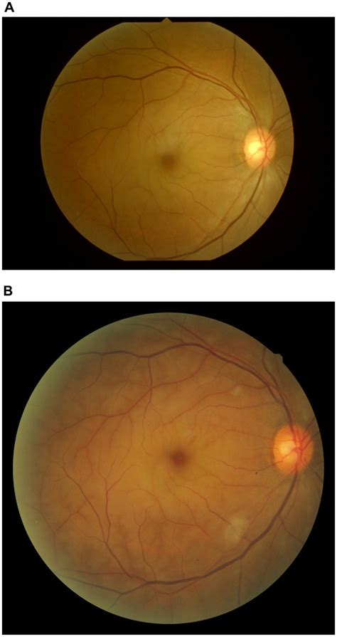 Color photograph of the right fundus showing a cherry-red spot in the... | Download Scientific ...