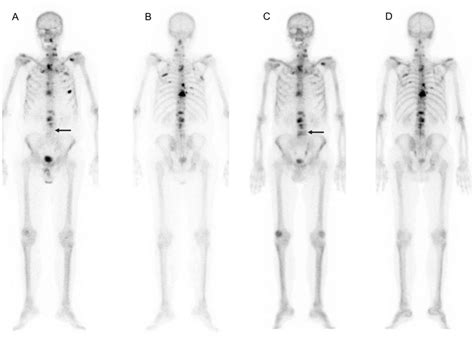 Radium implant for cervical cancer - mainetery