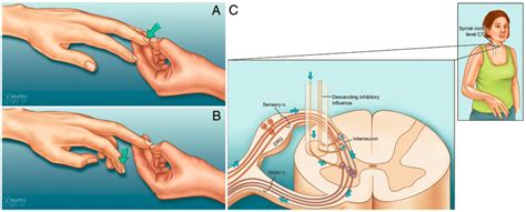 Physio Meets Science on Twitter: "Great illustration of the Hoffmann sign 😍 https://pubmed.ncbi ...