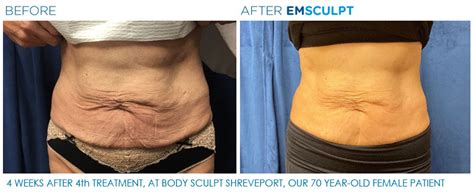 Emsculpt Before and After Photos - Anita Wang, MD