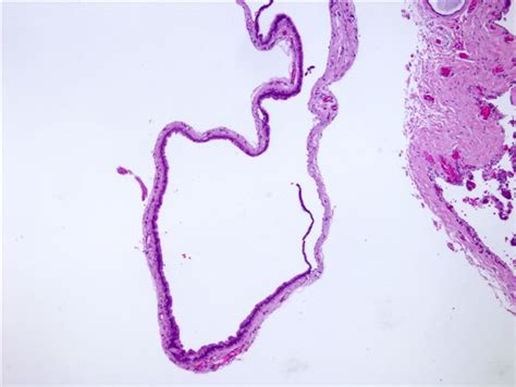 Pathology Outlines - Hidrocystoma