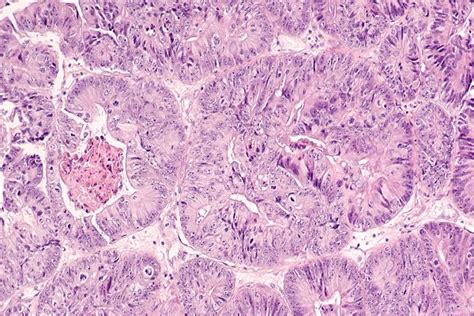 Metastatic Endometrial Cancer (Stage 4 Cancer) - DiseaseFix