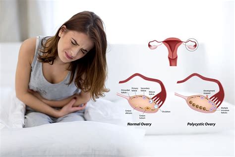 (PCOS) Polycystic ovary syndrome symptoms and causes