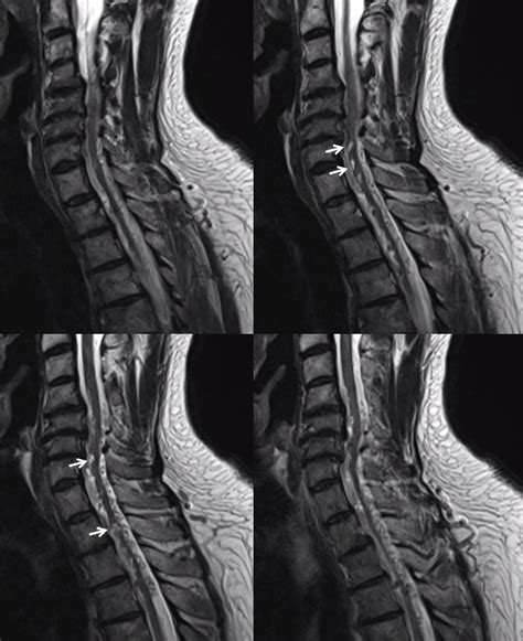 Spinal Epidural AVM Embolization | neuroangio.org