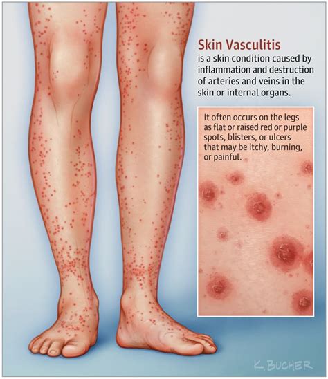 This Patient Page describes vasculitis, focusing especially on skin ...