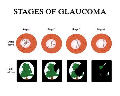 Are You Sure You Don't Have Glaucoma?