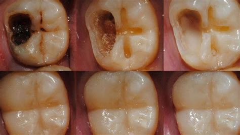 Scientists Develop Gel That Can Regrow Tooth Enamel