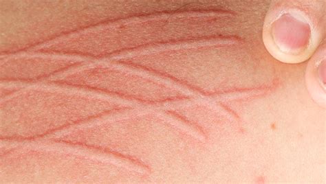 Dermatographia: Symptoms, Causes, Treatment, and More