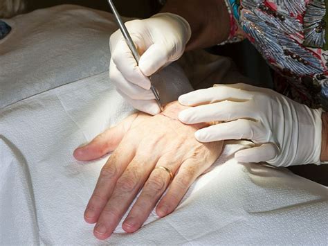 Melanoma Surgery: Procedure, Different Types, and Recovery