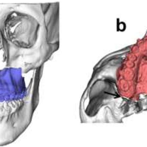 Scheme of SARME with three segments. a Frontal view: one posterior... | Download Scientific Diagram