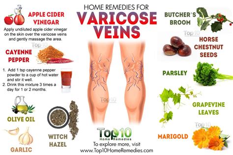 Home Remedies for Varicose Veins | Top 10 Home Remedies