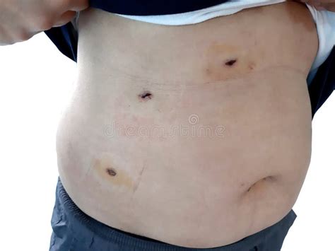 Scars from Gallbladder Surgery Stock Image - Image of cholecystectomy, appendix: 305900267