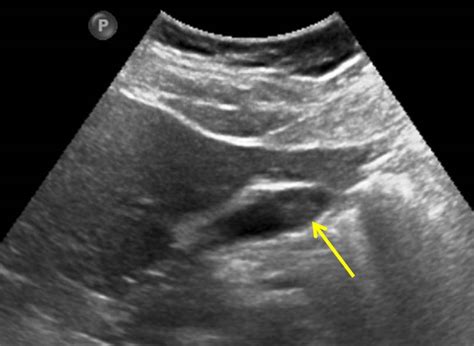 Gallbladder polyp – Radiology Cases