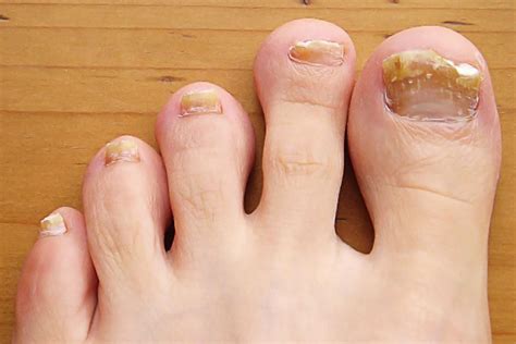 Common Toenail Problem Symptoms, Causes, and Treatment