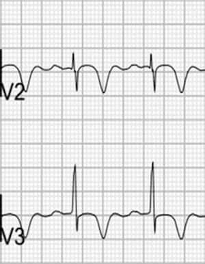 Wellens Syndrome • LITFL • ECG Library Eponym