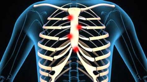 Understanding Costochondritis: Symptoms, Diagnosis, and Treatment - PUNE.NEWS