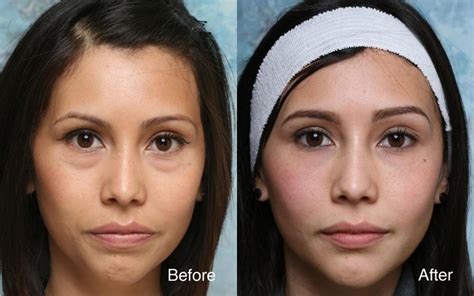 Eye Bag Surgery Before And After | Sexiz Pix