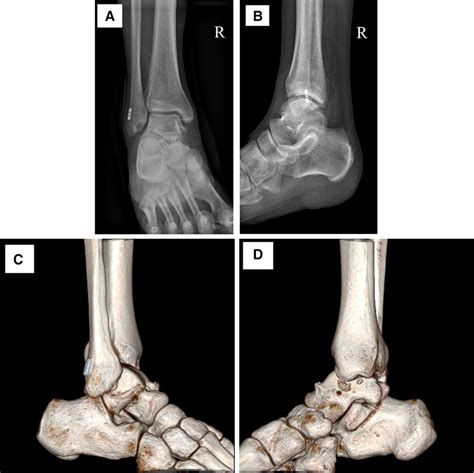 A typical case of the anterior talofibular ligament injury after... | Download Scientific Diagram