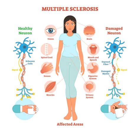 Multiple Sclerosis: Risk factors