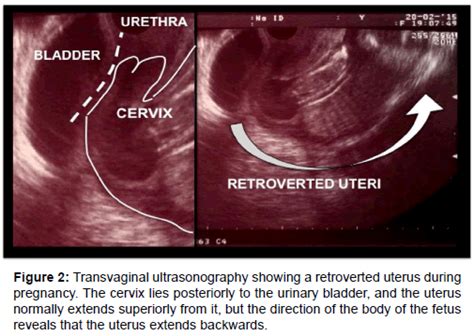 Retroverted Retroflexed Uterus Ultrasound