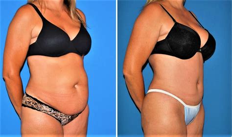 Abdominoplasty Surgery - Recovery, Before and After, Risks