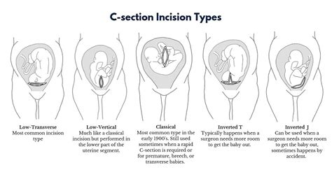 C section - Transverse Baby | BabyCenter