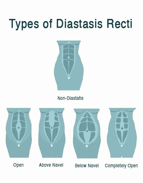 Diastasis Recti: Abdominal Separation FAQs - The Iskandar Complex Hernia Center