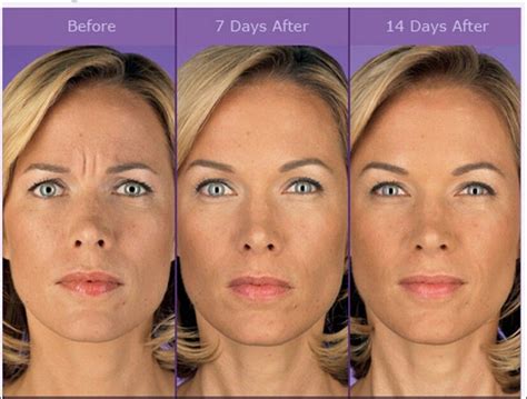 Before and after Botox injection #AntiAgingTips #AcneScarsRemedies #AntiAgingBeautyTips | Botox ...