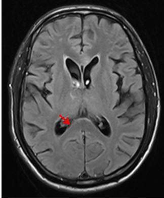 A case of acute corpus callosum infarction - CT and MRI findings | Eurorad