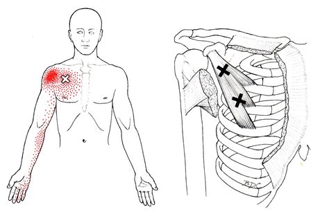 Pectoralis Minimus | The Trigger Point & Referred Pain Guide