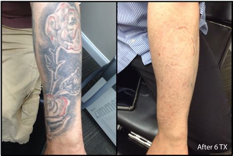 Before-After-Tattoo-Removal-Results-2019 - InkAway Laser Tattoo Removal