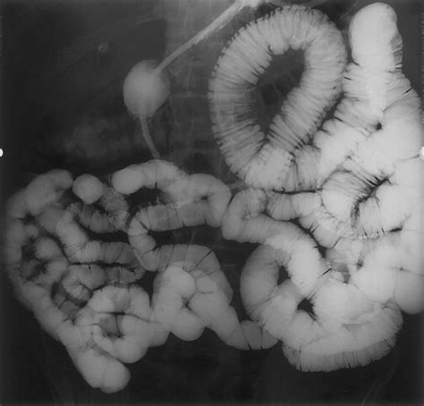 MR Enteroclysis Imaging of Crohn Disease | RadioGraphics