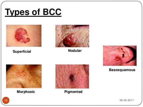 What Is Rodent Ulcer Meaning - Ideas of Europedias