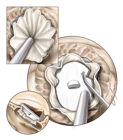 Craniopharyngioma (Endonasal Approach) | The Neurosurgical Atlas