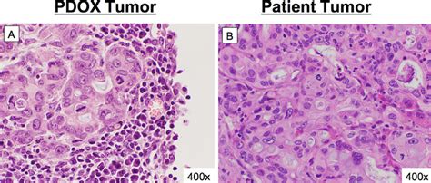 Concordance between patient histology and pancreatic cancer PDOX.... | Download Scientific Diagram