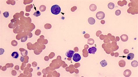 Blood from a dog with immune-mediated hemolytic anemia: nRBC vs lymph | eClinpath