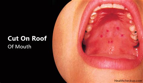 Cut on Roof of Mouth - Causes, Treatment, Prevention by Dr. Himanshi